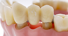 Несъемное протезирование зубов в Зуевке