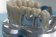 Имплантация зубов в Зуевке